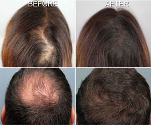 Hair-Mesotherapy-Treatment-in-Mumbai-India-300x248-1