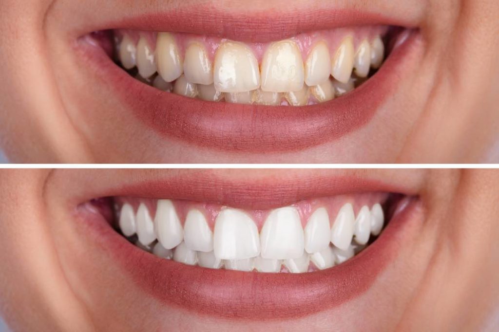 Two-photos-of-before-and-after-teeth-whitening-1024x682