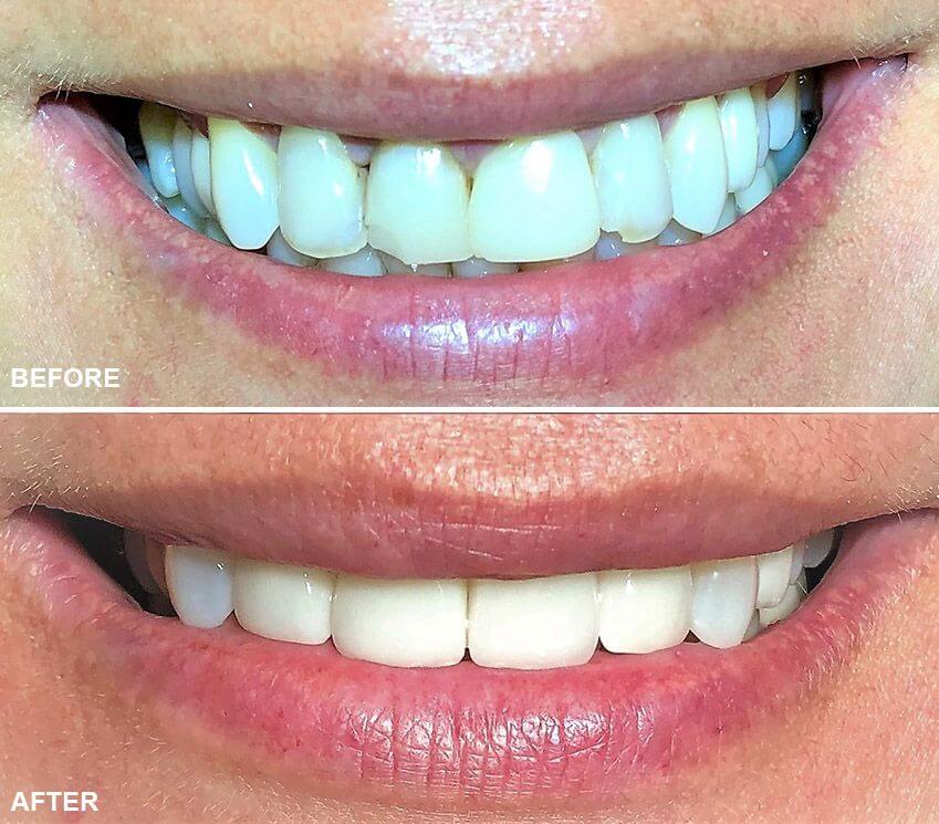 Zirconia-crown-before-and-after