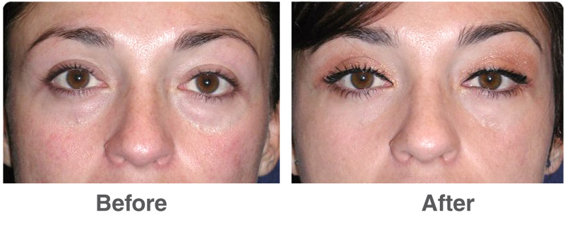 before-after-eye-surgery-3