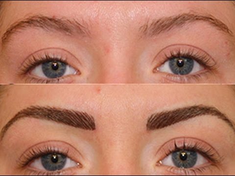 hair-transplant-to-eyebrows