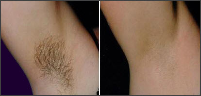 laser-hair-removal-before-and-after-photos