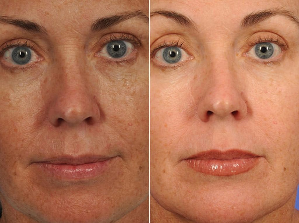 peels-and-microdermabrasion-before-after-10-1024x766-1