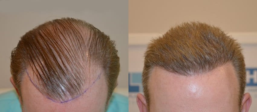 price-DHI-hair-transplant-turkey