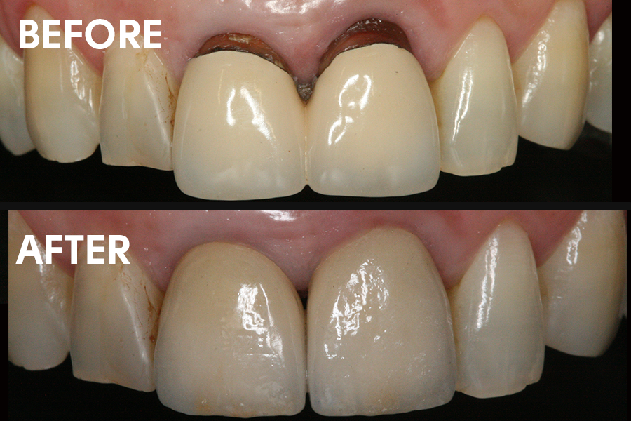 Improving-crowns-MAIN-image-2022