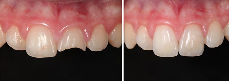 iv-restorations